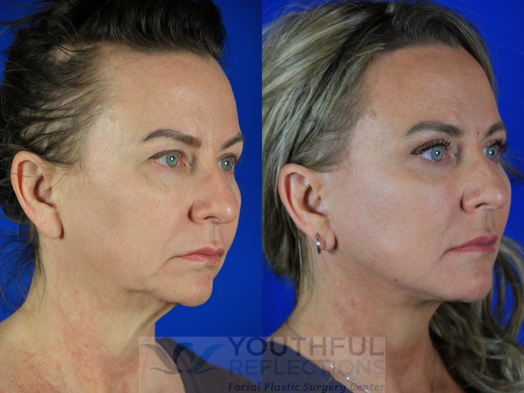 Facelift / Reflection Lift Case 133 Before & After Right Oblique | Nashville, TN | Youthful Reflections