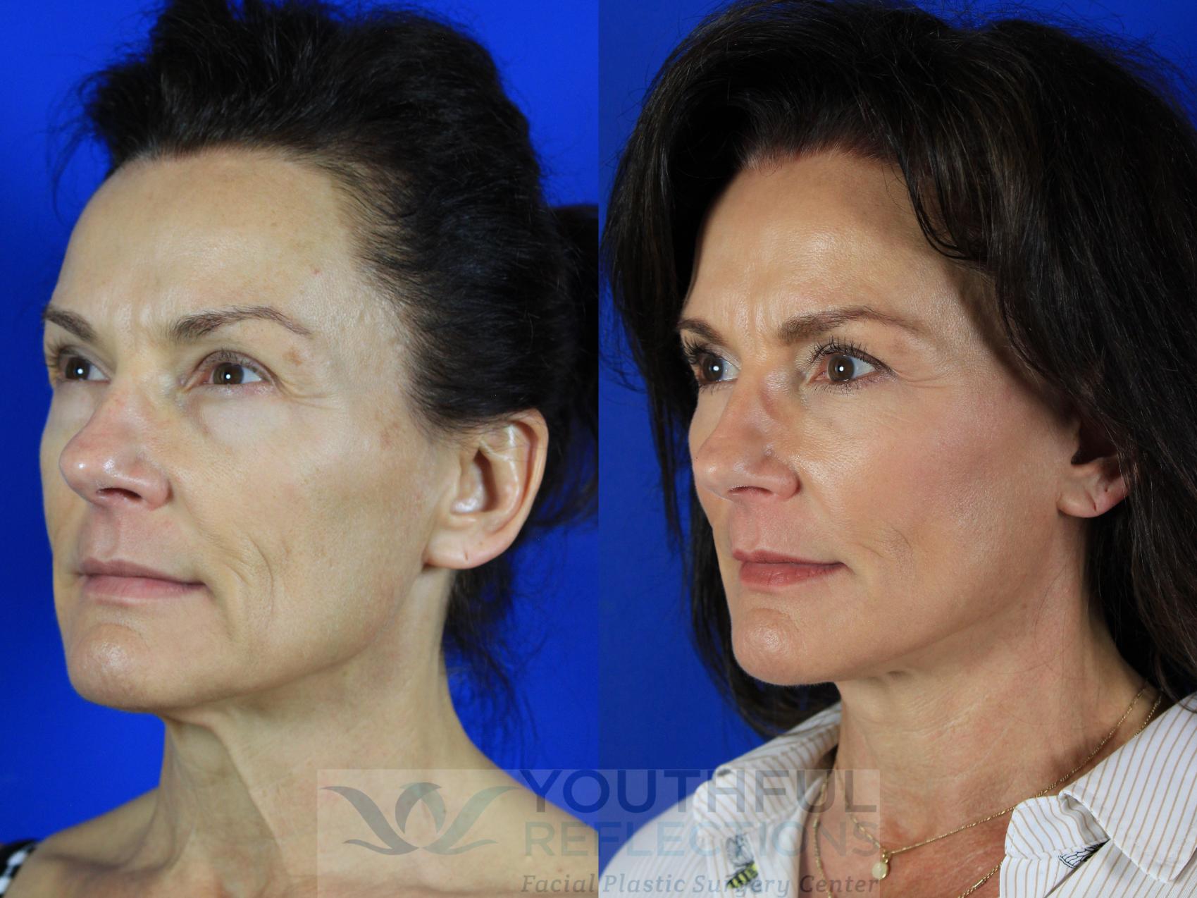 Facelift / Reflection Lift Case 134 Before & After Left Oblique | Nashville, TN | Youthful Reflections