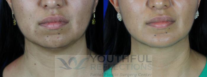 Chin Implant Case 107 Before & After Front | Nashville, TN | Youthful Reflections