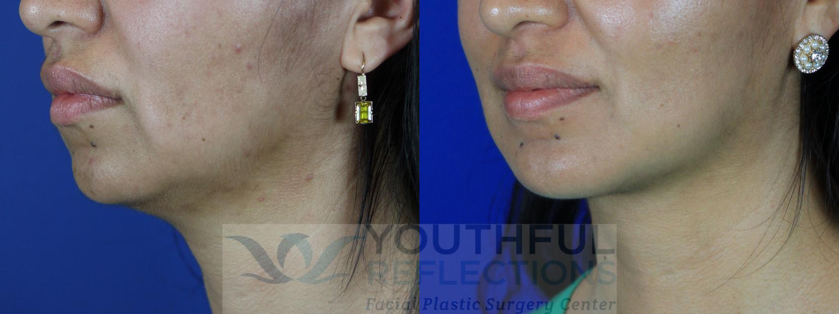 Chin Implant Case 107 Before & After Left Oblique | Nashville, TN | Youthful Reflections