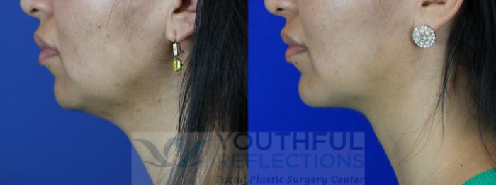 Chin Implant Case 107 Before & After Left Side | Nashville, TN | Youthful Reflections