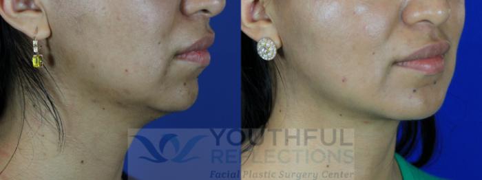 Chin Implant Case 107 Before & After Right Oblique | Nashville, TN | Youthful Reflections