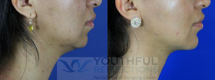 Chin Implant Case 107 Before & After Right Side | Nashville, TN | Youthful Reflections