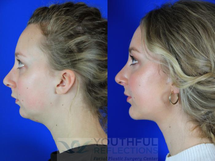 Chin Implant Case 118 Before & After Left Side | Nashville, TN | Youthful Reflections