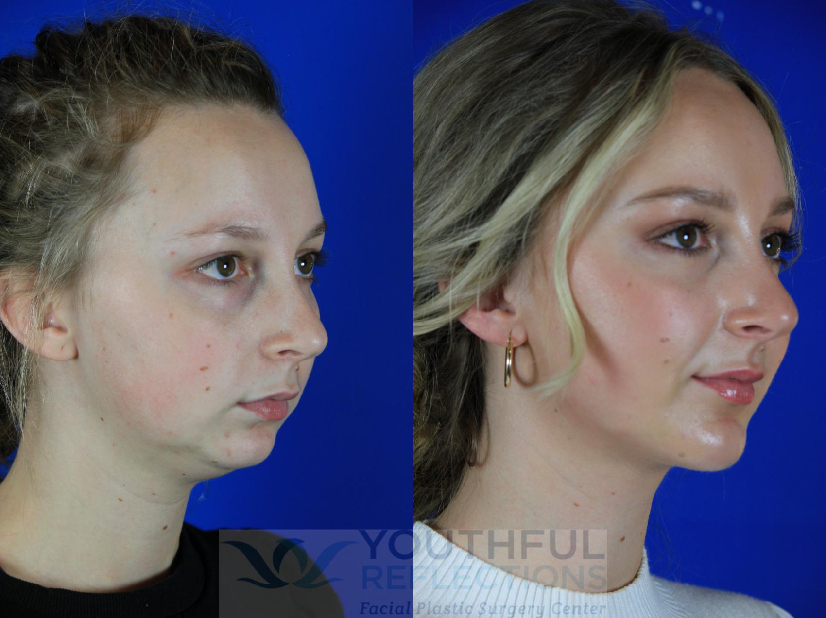 Chin Implant Case 118 Before & After Right Oblique | Nashville, TN | Youthful Reflections