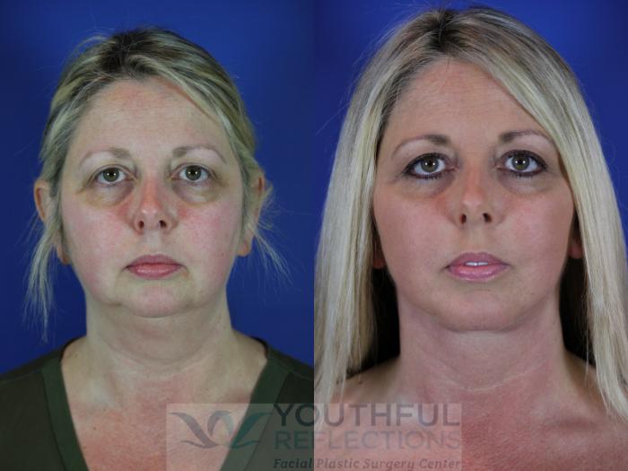 Chin Implant Case 64 Before & After Front | Nashville, TN | Youthful Reflections