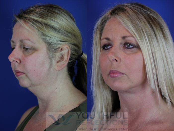 Chin Implant Case 64 Before & After Left Oblique | Nashville, TN | Youthful Reflections