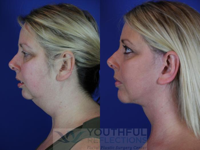 Chin Implant Case 64 Before & After Left Side | Nashville, TN | Youthful Reflections