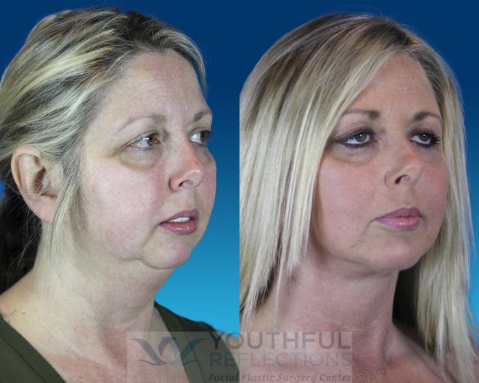 Chin Implant Case 64 Before & After Right Oblique | Nashville, TN | Youthful Reflections
