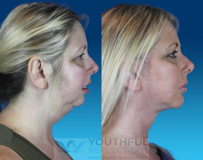 Chin Implant Case 64 Before & After Right Side | Nashville, TN | Youthful Reflections