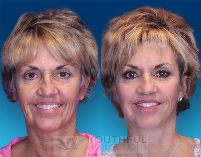 Facelift / Reflection Lift Case 1 Before & After Front | Nashville, TN | Youthful Reflections