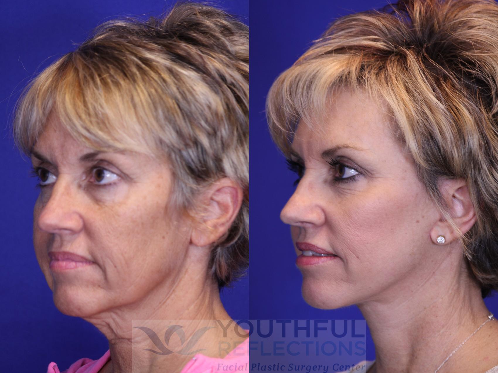 Facelift / Reflection Lift Case 1 Before & After Left Oblique | Nashville, TN | Youthful Reflections