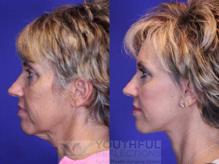 Facelift / Reflection Lift Case 1 Before & After Left Side | Nashville, TN | Youthful Reflections