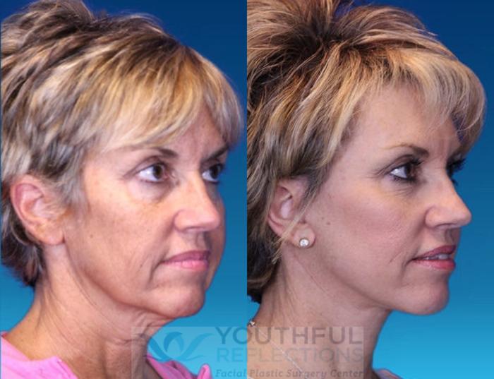 Facelift / Reflection Lift Case 1 Before & After Right Oblique | Nashville, TN | Youthful Reflections