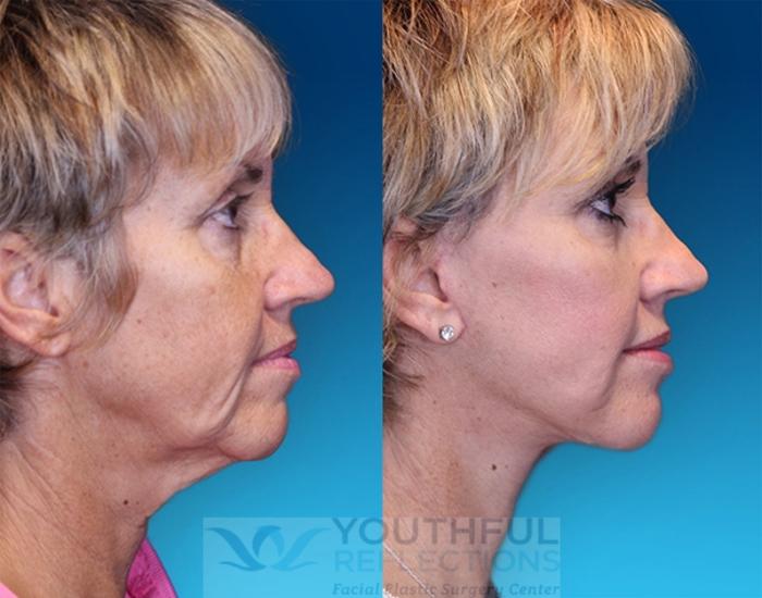 Facelift / Reflection Lift Case 1 Before & After Right Side | Nashville, TN | Youthful Reflections