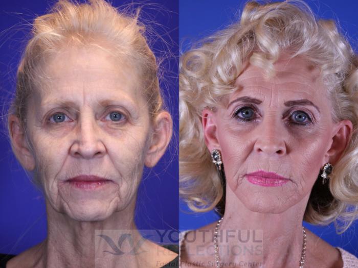 Facelift / Reflection Lift Case 10 Before & After Front | Nashville, TN | Youthful Reflections