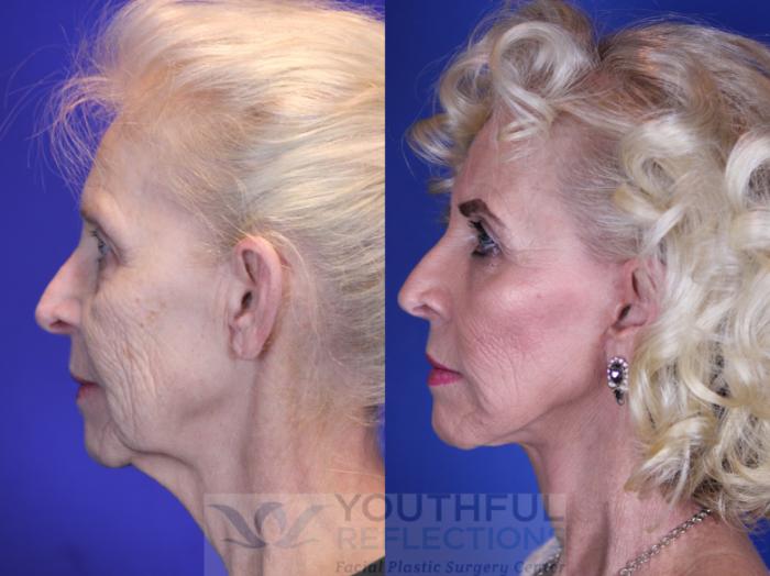 Facelift / Reflection Lift Case 10 Before & After Left Side | Nashville, TN | Youthful Reflections