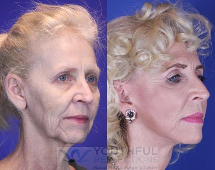 Facelift / Reflection Lift Case 10 Before & After Right Oblique | Nashville, TN | Youthful Reflections