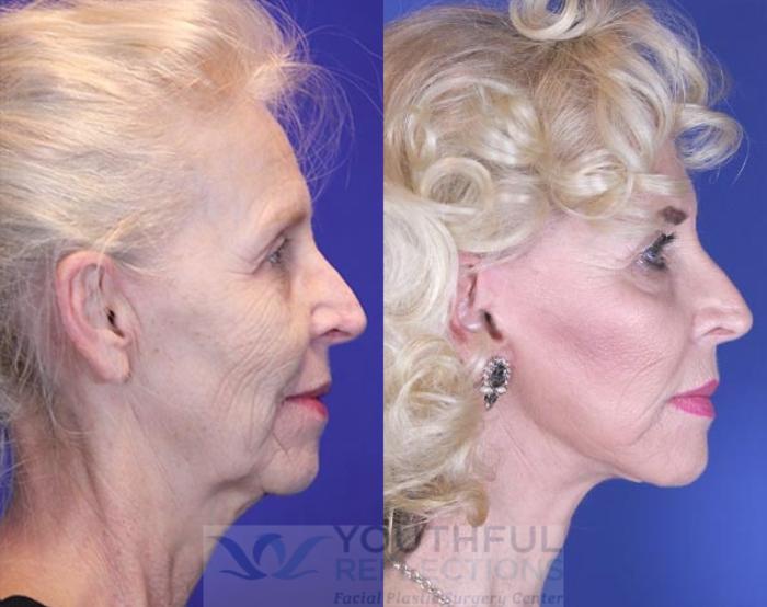Facelift / Reflection Lift Case 10 Before & After Right Side | Nashville, TN | Youthful Reflections
