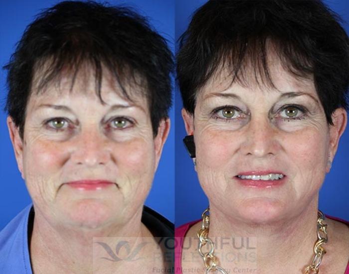 Facelift / Reflection Lift Case 11 Before & After Front | Nashville, TN | Youthful Reflections