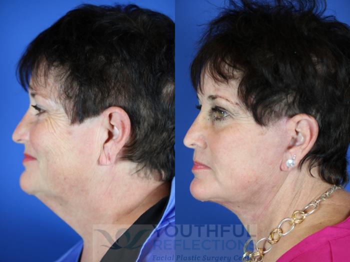 Facelift / Reflection Lift Case 11 Before & After Left Side | Nashville, TN | Youthful Reflections