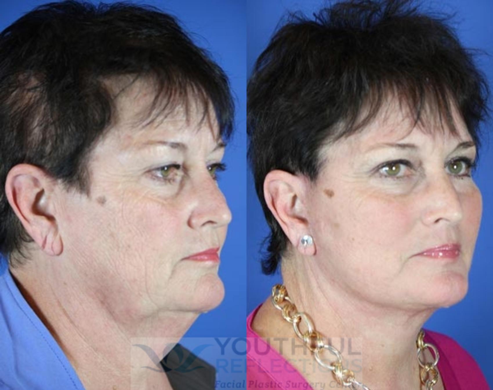 Facelift / Reflection Lift Case 11 Before & After Right Oblique | Nashville, TN | Youthful Reflections