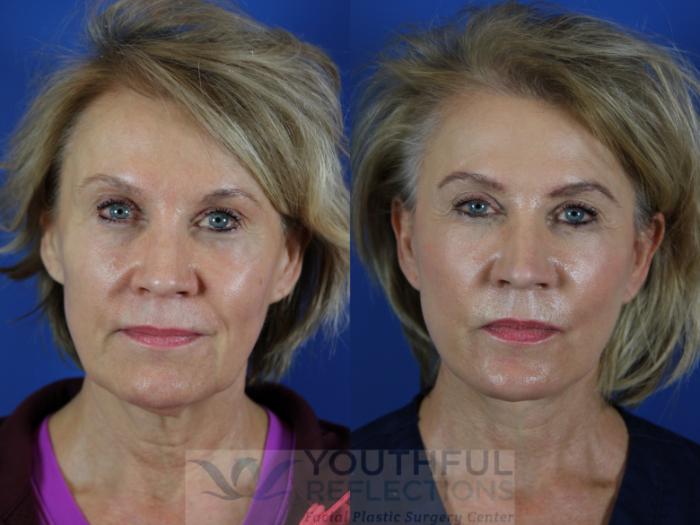 Facelift / Reflection Lift Case 110 Before & After Front | Nashville, TN | Youthful Reflections
