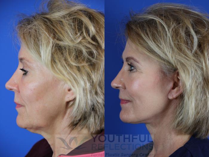 Facelift / Reflection Lift Case 110 Before & After Left Side | Nashville, TN | Youthful Reflections