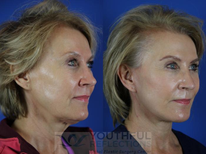 Facelift / Reflection Lift Case 110 Before & After Right Oblique | Nashville, TN | Youthful Reflections