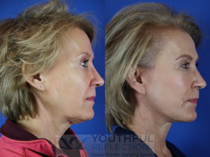 Facelift / Reflection Lift Case 110 Before & After Right Side | Nashville, TN | Youthful Reflections