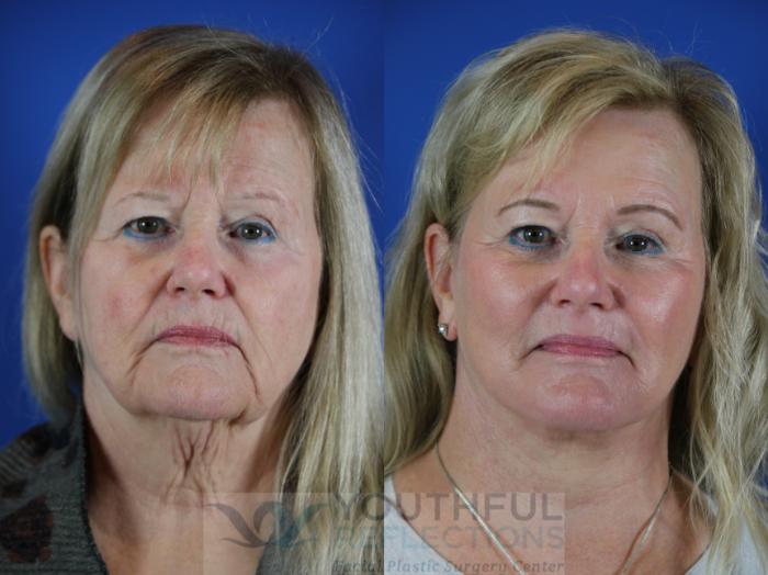Facelift / Reflection Lift Case 111 Before & After Front | Nashville, TN | Youthful Reflections