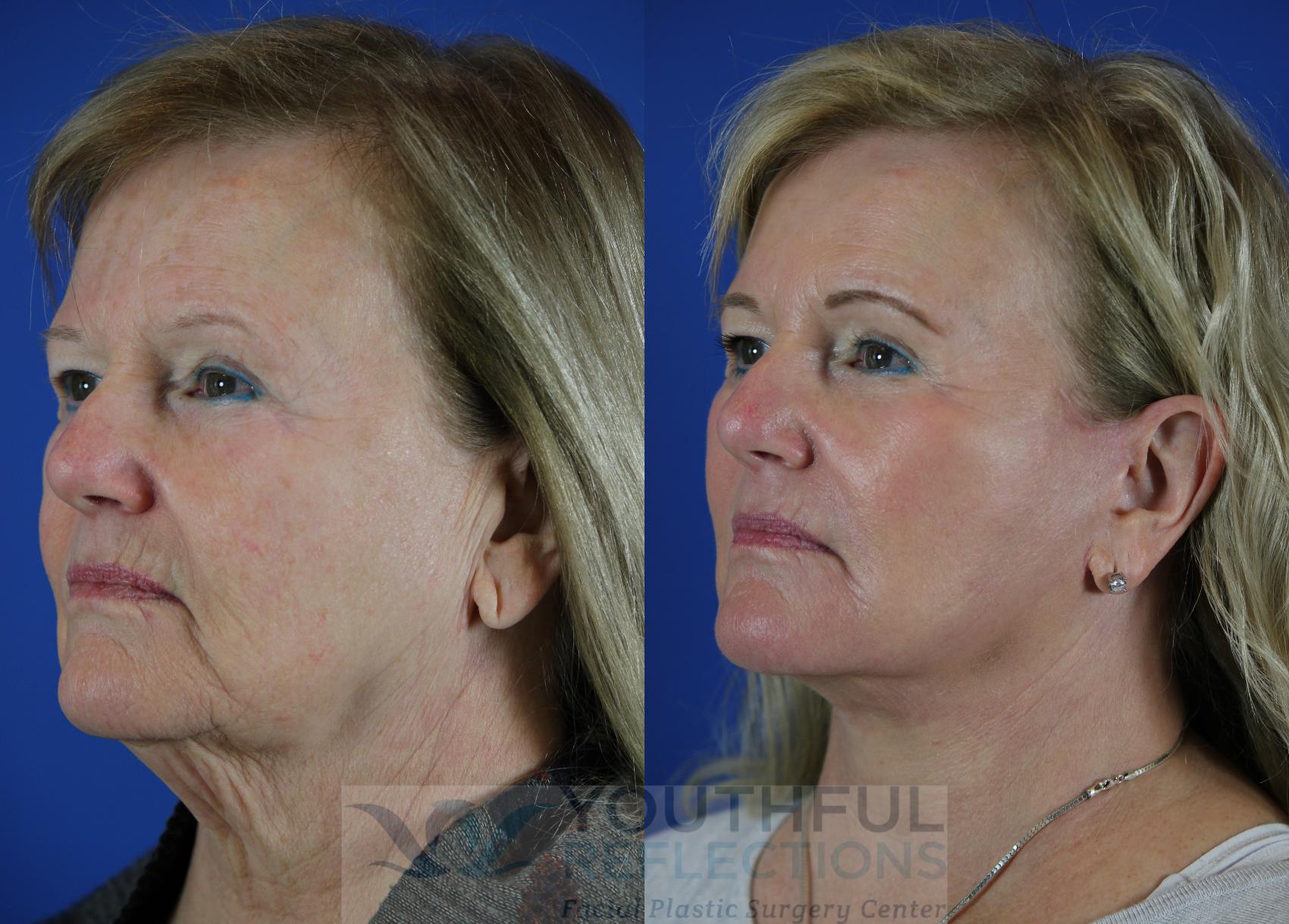 Fat Transfer Case 111 Before & After Left Oblique | Nashville, TN | Youthful Reflections