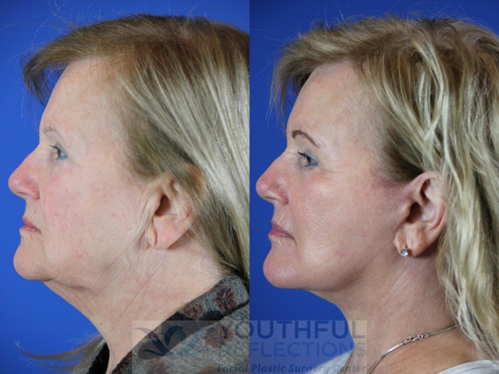 Facelift / Reflection Lift Case 111 Before & After Left Side | Nashville, TN | Youthful Reflections