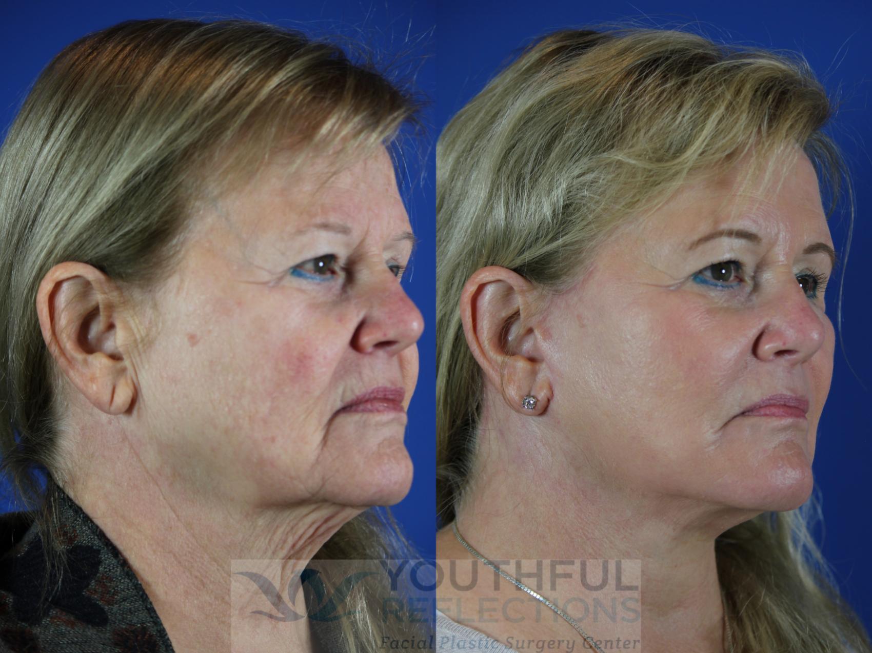 Facelift / Reflection Lift Case 111 Before & After Right Oblique | Nashville, TN | Youthful Reflections