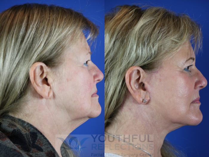 Facelift / Reflection Lift Case 111 Before & After Right Side | Nashville, TN | Youthful Reflections