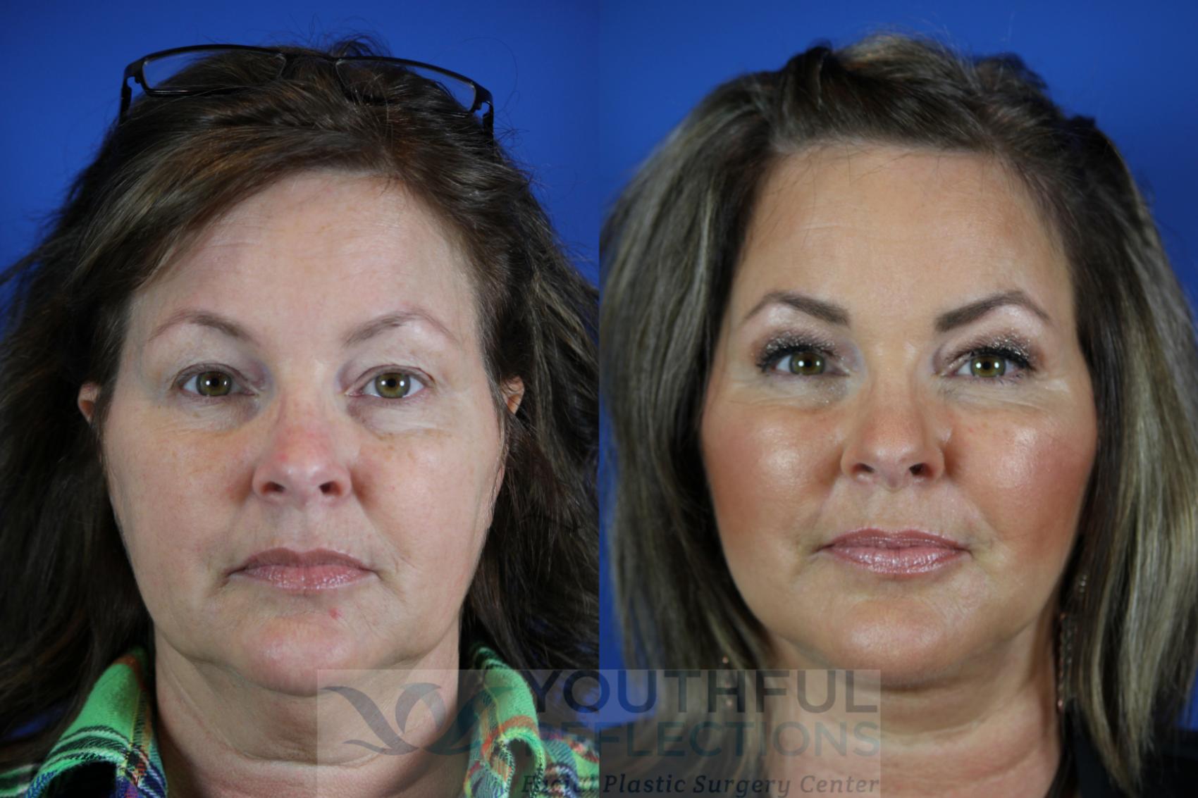 Facelift / Reflection Lift Case 112 Before & After Front | Nashville, TN | Youthful Reflections