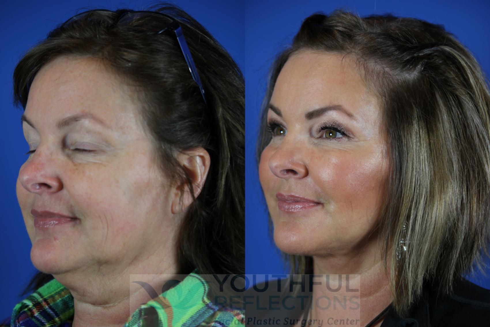 Fat Transfer Case 112 Before & After Left Oblique | Nashville, TN | Youthful Reflections