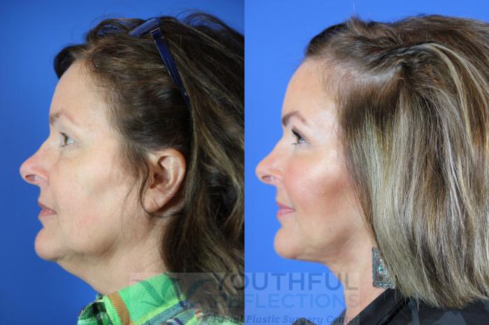 Facelift / Reflection Lift Case 112 Before & After Left Side | Nashville, TN | Youthful Reflections