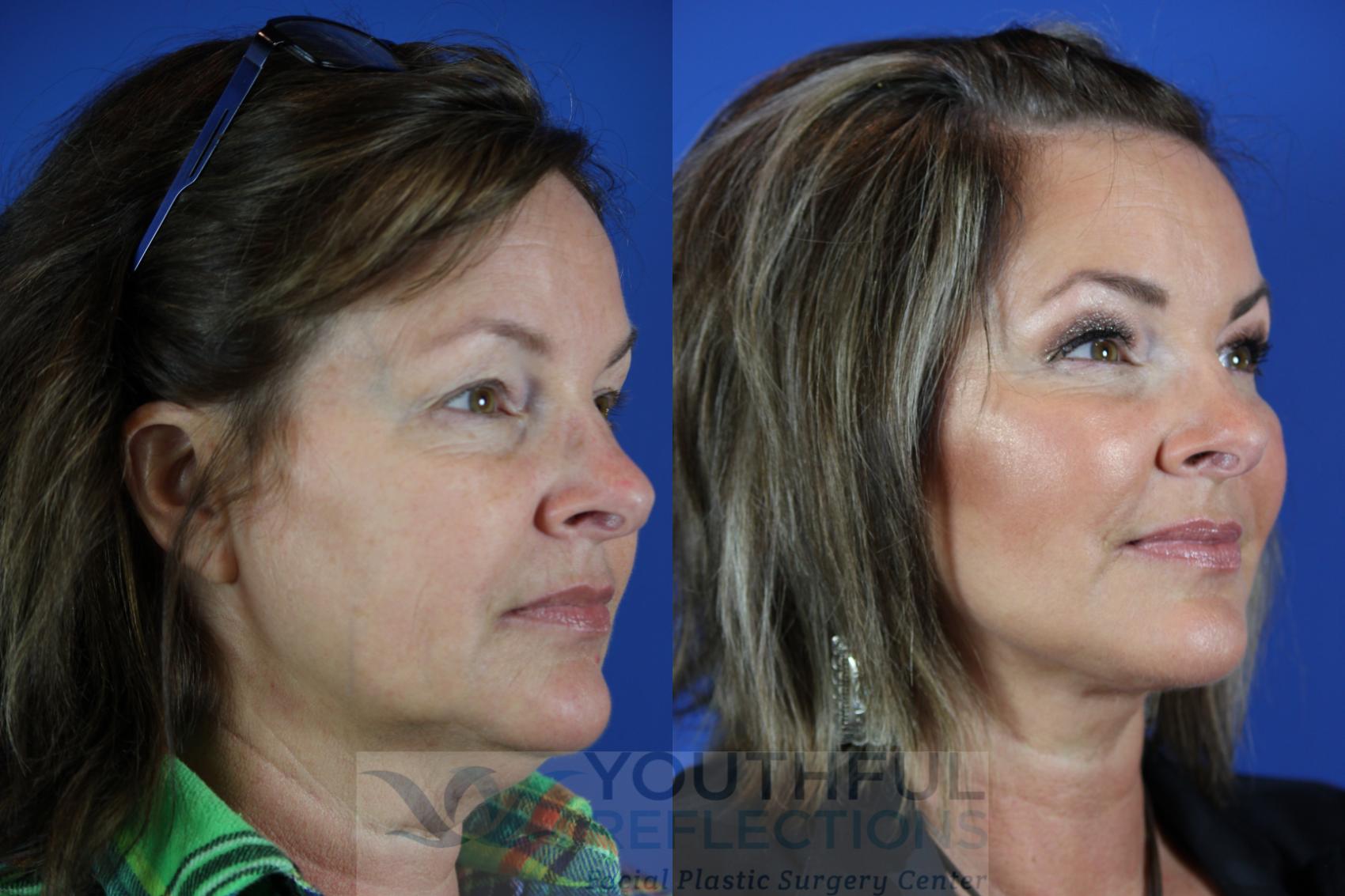 Fat Transfer Case 112 Before & After Right Oblique | Nashville, TN | Youthful Reflections