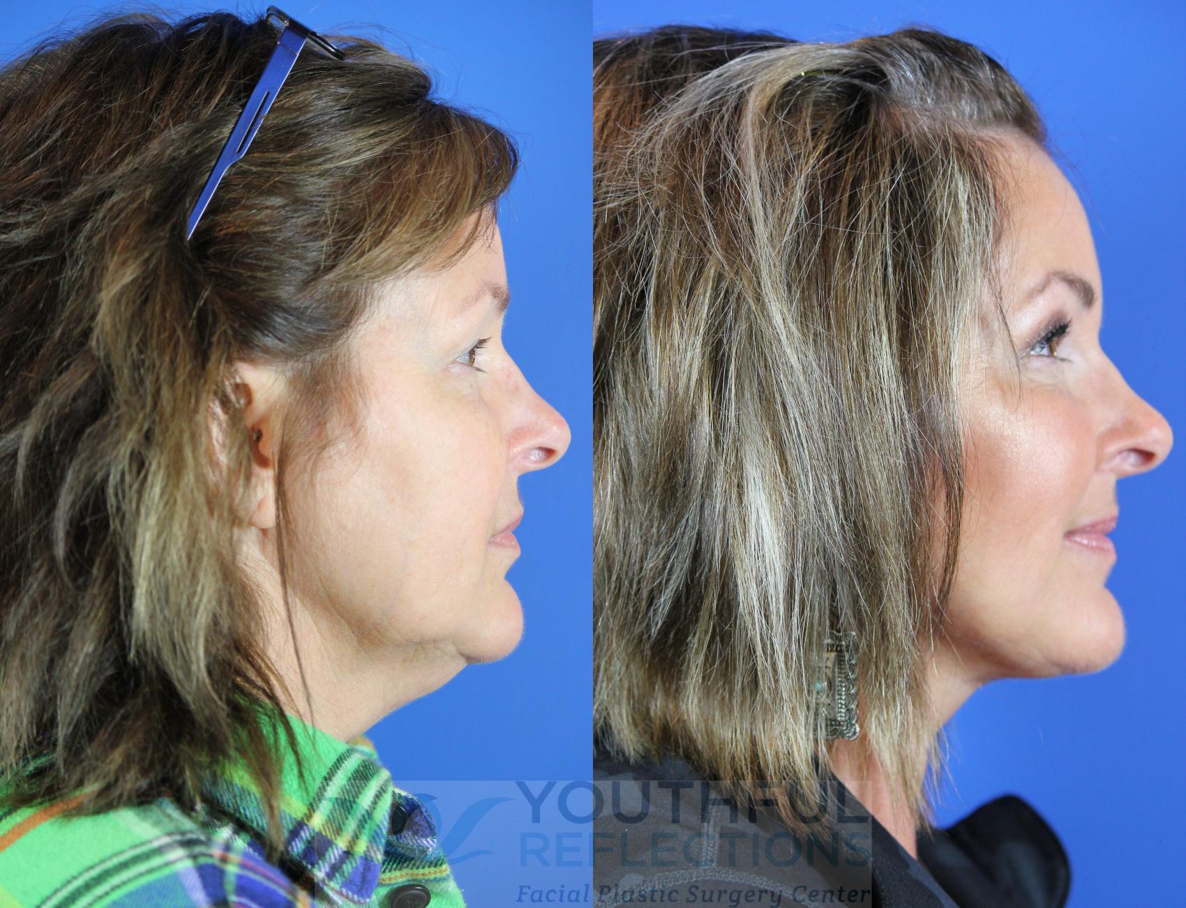 Fat Transfer Case 112 Before & After Right Side | Nashville, TN | Youthful Reflections