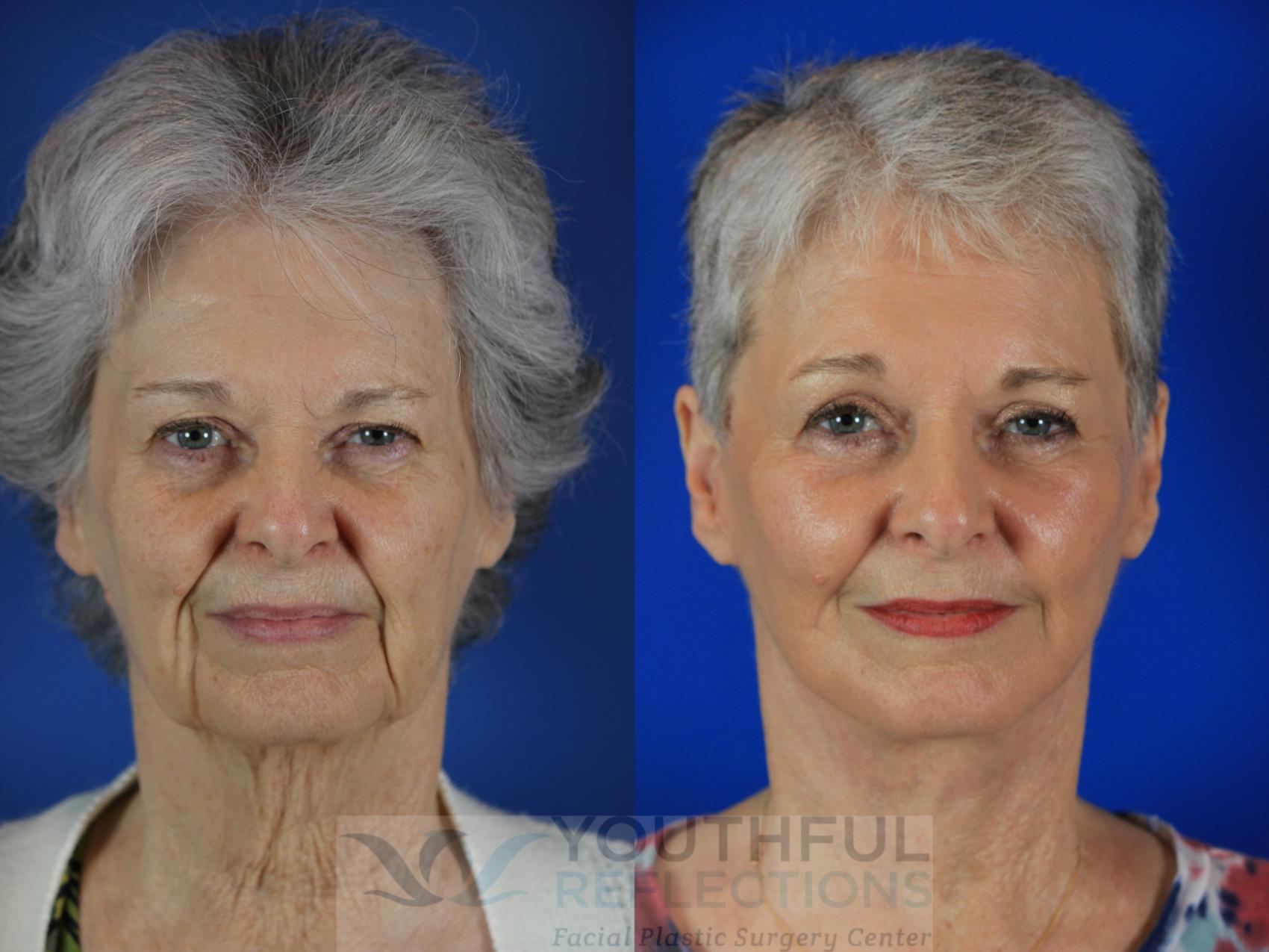 Facelift / Reflection Lift Case 113 Before & After Front | Nashville, TN | Youthful Reflections