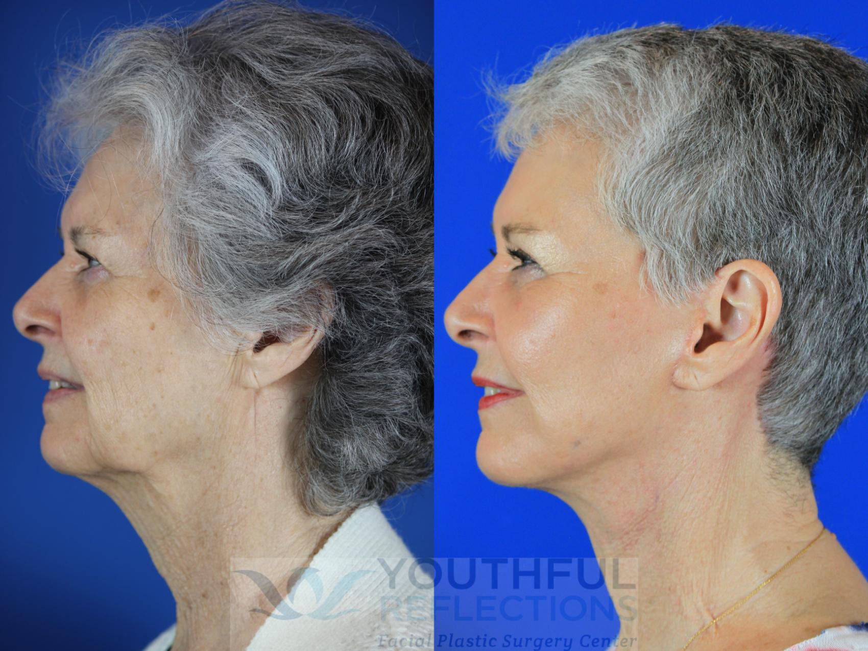 Facelift / Reflection Lift Case 113 Before & After Left Side | Nashville, TN | Youthful Reflections
