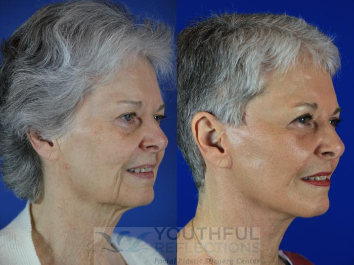 Facelift / Reflection Lift Case 113 Before & After Right Oblique | Nashville, TN | Youthful Reflections