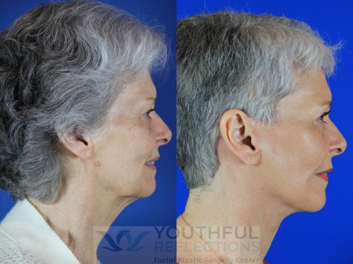 CO2 Laser Skin Resurfacing Case 113 Before & After Right Side | Nashville, TN | Youthful Reflections