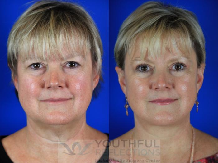 Brow Lift Case 114 Before & After Front | Nashville, TN | Youthful Reflections