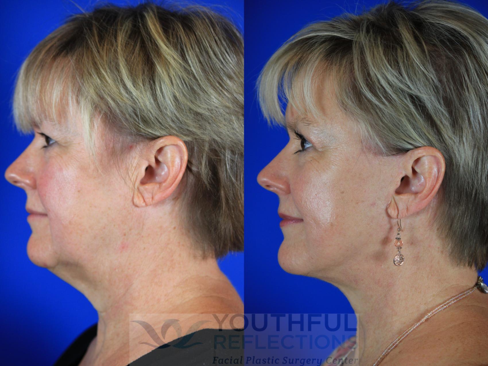 Facelift / Reflection Lift Case 114 Before & After Left Side | Nashville, TN | Youthful Reflections