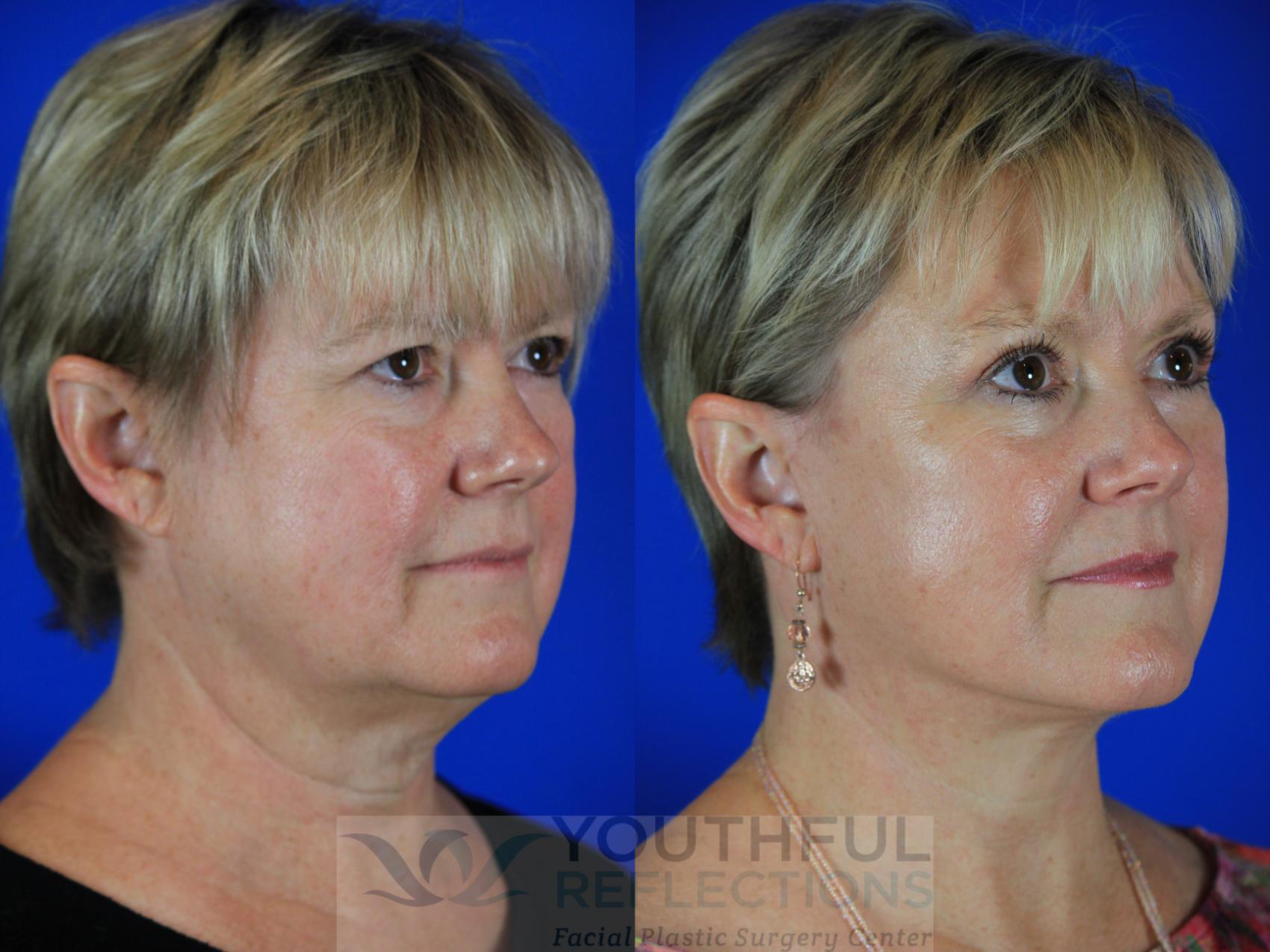 Facelift / Reflection Lift Case 114 Before & After Right Oblique | Nashville, TN | Youthful Reflections