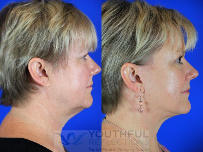 Facelift / Reflection Lift Case 114 Before & After Right Side | Nashville, TN | Youthful Reflections