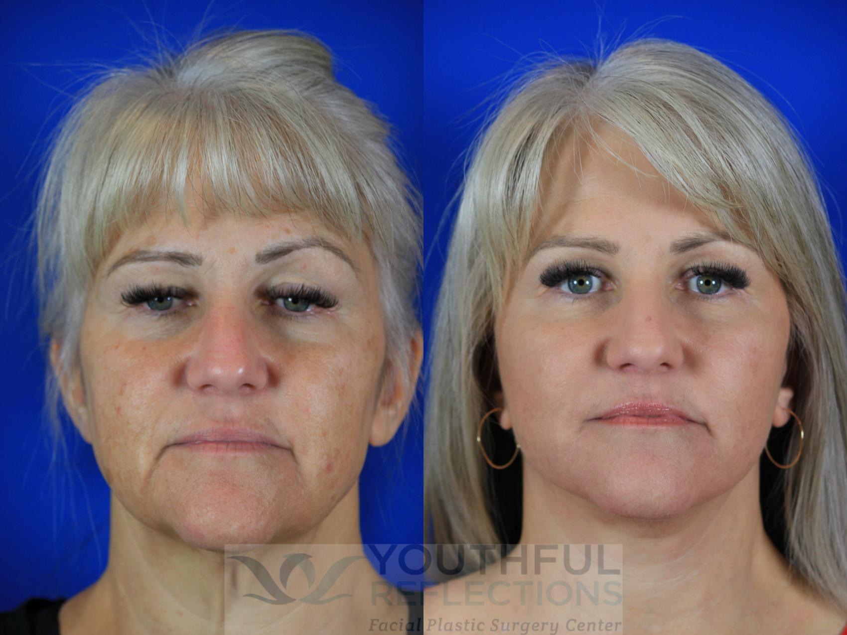 Facelift / Reflection Lift Case 115 Before & After Front | Nashville, TN | Youthful Reflections