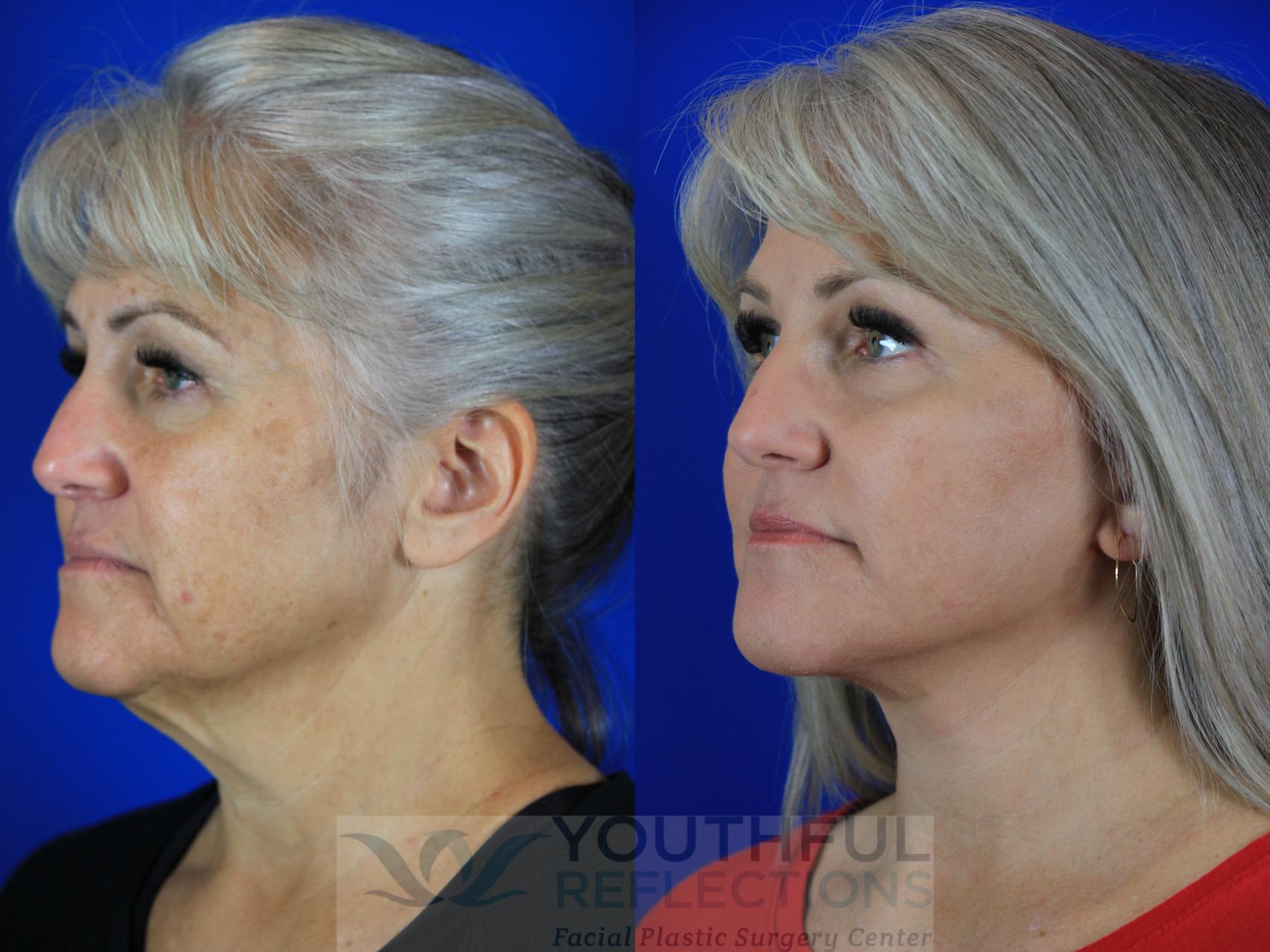 Fat Transfer Case 115 Before & After Left Oblique | Nashville, TN | Youthful Reflections